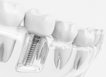 dental implant in Lewisville